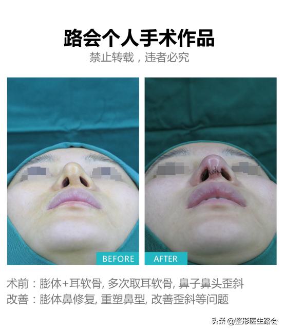 做的耳软骨鼻塌下去了怎么修复啊,做了耳软骨鼻如何不塌