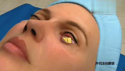 “祛眼袋”这件事,您试过几种妙招?说实话“还是手术靠谱”