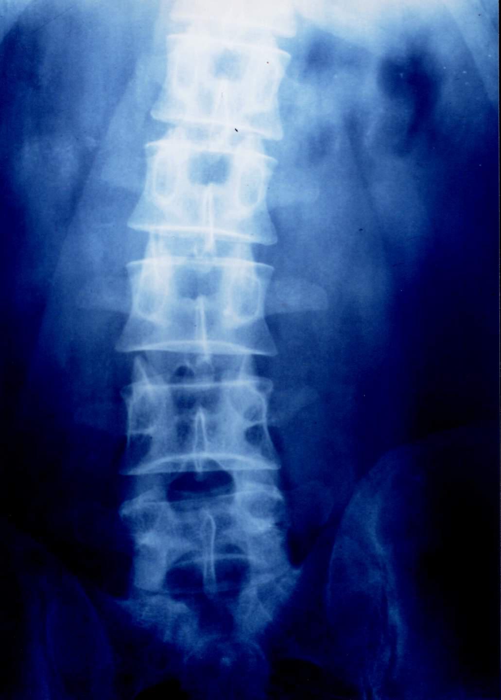 腰椎间盘突出你了解吗,腰椎间盘突出症的科普问答