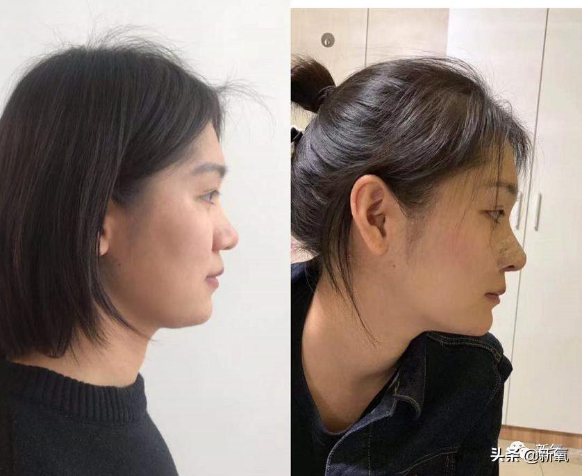 村姑整成鞠婧祎的鼻子变天使,鞠婧祎的鼻子整过吗