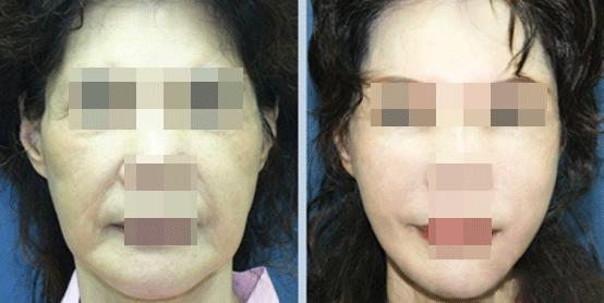 脸松弛下垂法令纹做什么医美手术,法令纹苹果肌下垂做什么手术