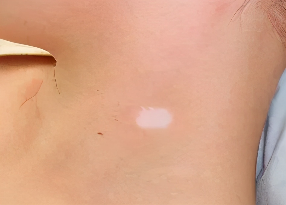 幼儿白癜风分几种类型啊,白癜风都有什么类型