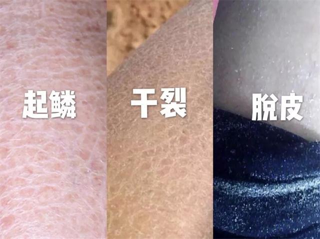 身体乳真实推荐解决皮肤干燥发痒,干痒粗糙起皮