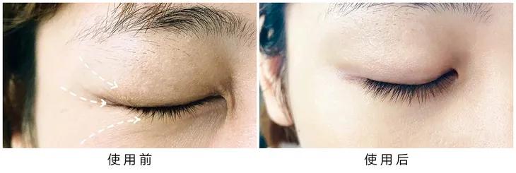 马应龙去除眼纹,马应龙去细纹