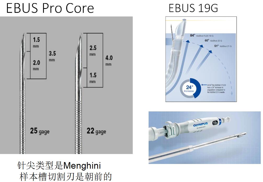 小细胞肺癌的气管镜介入治疗,导航支气管镜在肺癌诊断中的应用