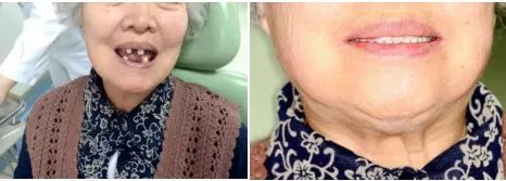 国家有关于牙齿的补贴吗,牙齿补贴报销政策