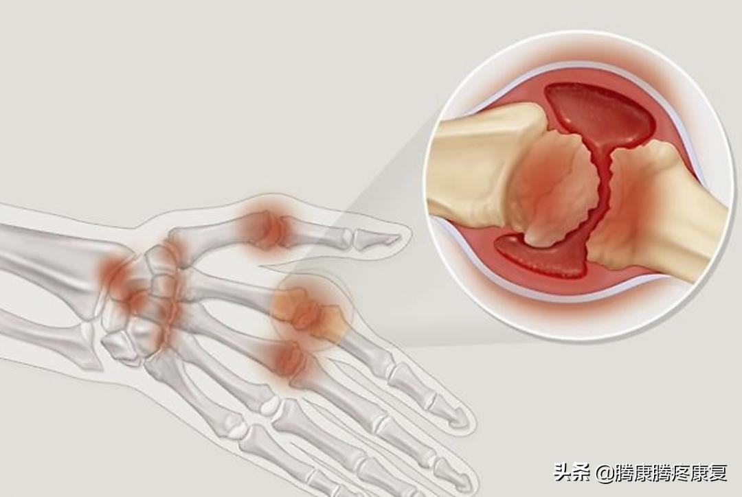 类风湿关节炎病因与发病机制,类风湿关节炎的病因与发病机制