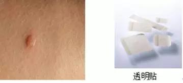 压疮液体敷料怎么用,压疮的治疗首选敷料