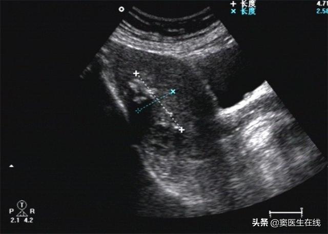 绝经太晚容易得子宫内膜癌吗,绝经越晚是不是寿命越长