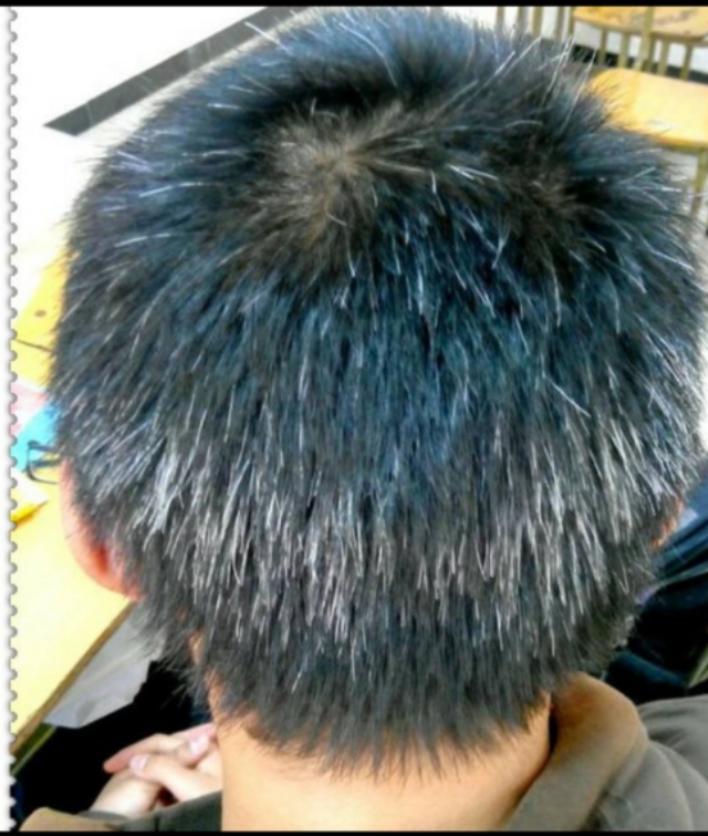 儿童白发的原因及治疗挂哪个科,儿童白发的原因怎么治疗