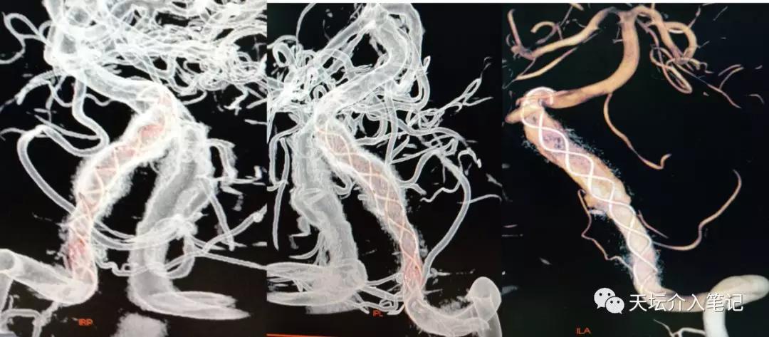 密网支架治疗脑动脉瘤术后效果图,密网支架治疗基底动脉假性动脉瘤