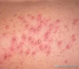 皮肤病毛囊炎,皮肤毛囊炎的原因和症状