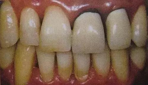 换一副烤瓷牙什么材料比较好,各类烤瓷牙材料的优缺点对比