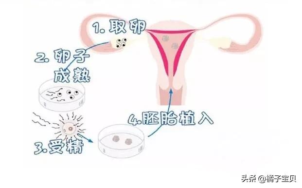 名医导航|什么是取卵?取卵的全过程