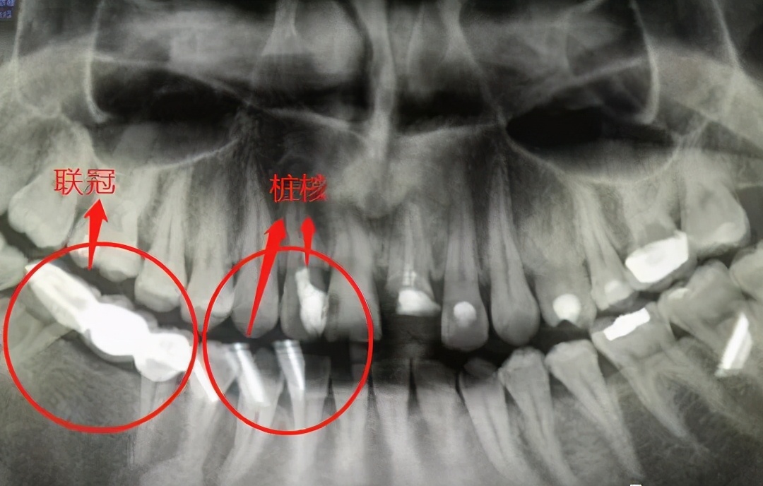 牙齿残根不疼不拔好吗,牙齿残根不疼