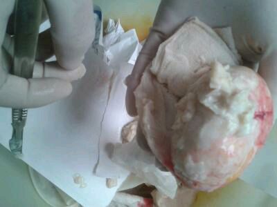 预防粉瘤,脂肪瘤怎样预防及治疗