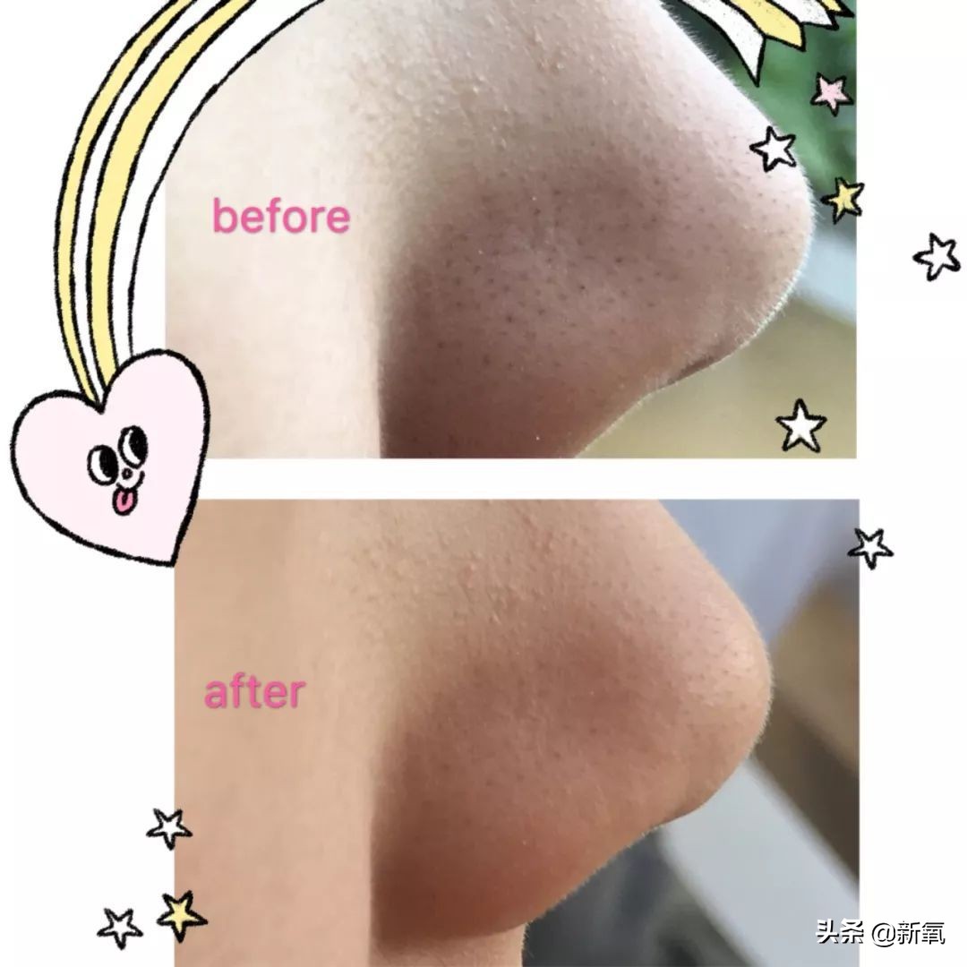 五分钟教你有效去黑头,最火去黑头收缩毛孔