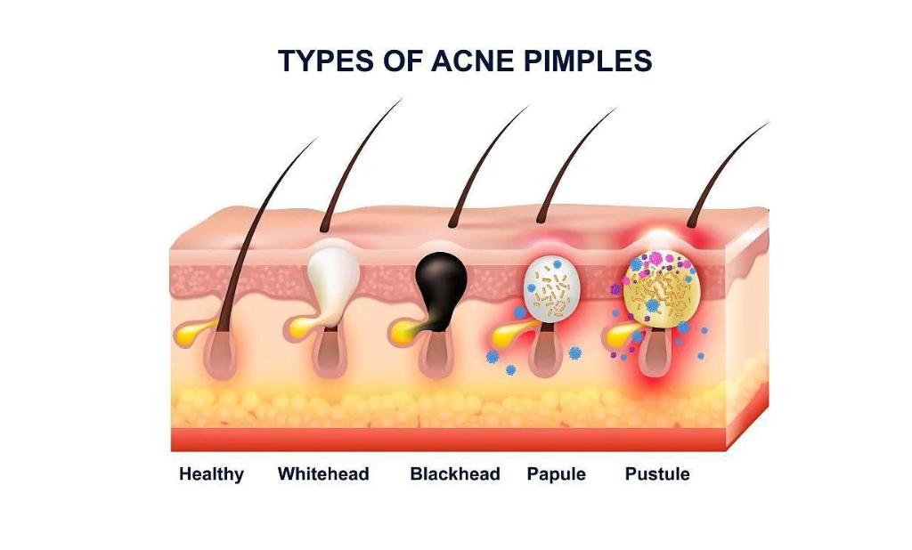 鼻子上挤出来的白色丝状物到底啥,鼻子上挤出来的白色丝是什么