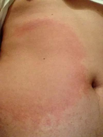 皮肤科红斑狼疮,中医能治皮肤红斑狼疮吗