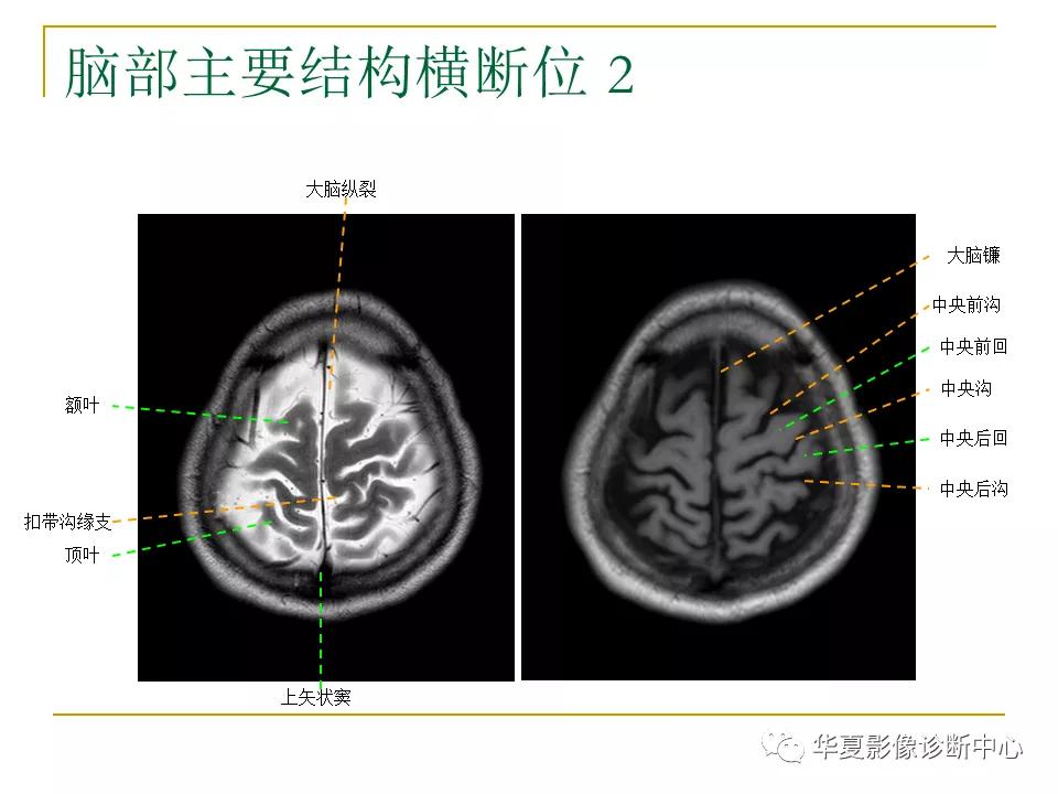 中国人脑立体定向mri应用解剖图谱,脑mri示意图