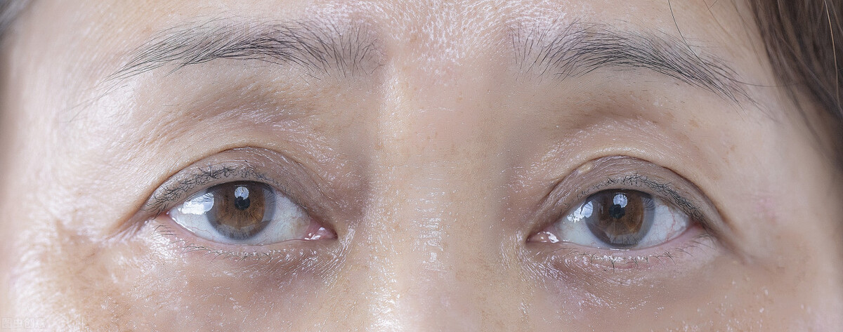 改善三眼皮的方法,眼皮成了三眼皮的原因