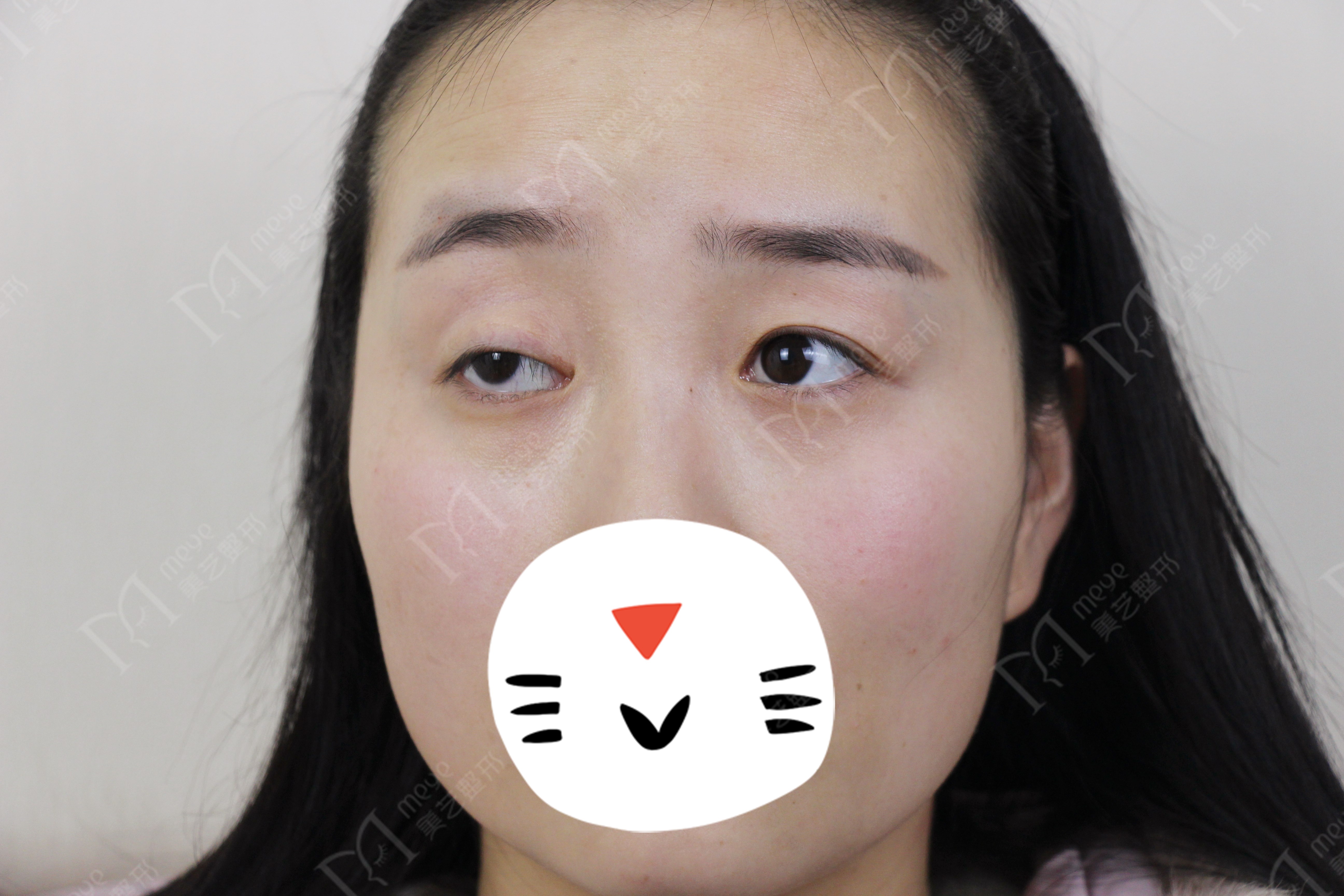 女子双眼皮术后大小眼,大小眼做了双眼皮感觉眼角不对称