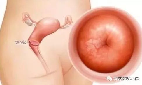 母亲节宫颈癌免费筛查,68岁有没有必要做宫颈癌筛查啊