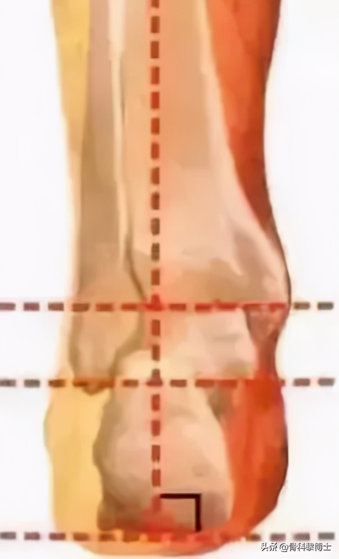 学生训练小腿疼痛是什么原因,中考体育1000米小腿痛