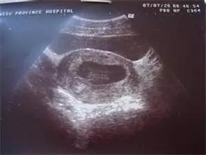 早孕试纸可以观察hcg吗,早孕期超声筛查是免费的吗