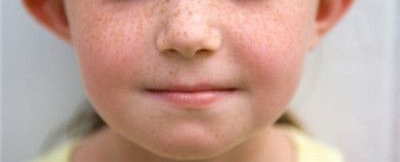 雀斑净能祛除雀斑吗,氢醌乳膏是淡化雀斑还是祛除雀斑