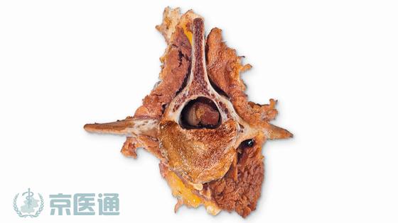 腰痛、腿痛是什么病？骨科医生用一块「羊蝎子」告诉你