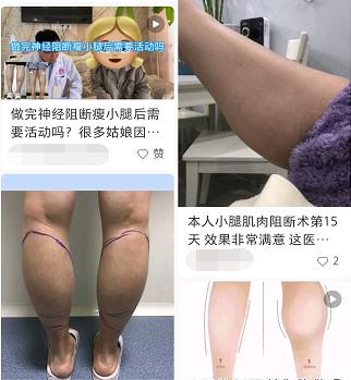 小腿阻断针,小腿阻断