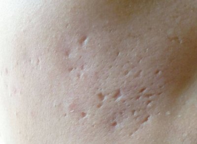 有痘印痘坑黑痘印应该用啥护肤品,脸上痘印太多治疗痘印痘坑的方法