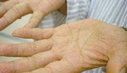 手脚出水泡奇痒难忍教你简单一招,手脚起水泡奇痒无比什么办法最好