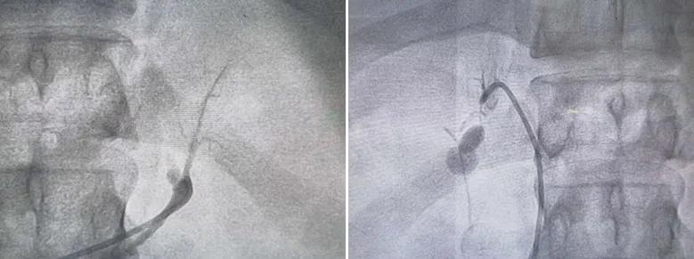 28岁男子患高血压8年未治,高血压患者瘫痪前兆