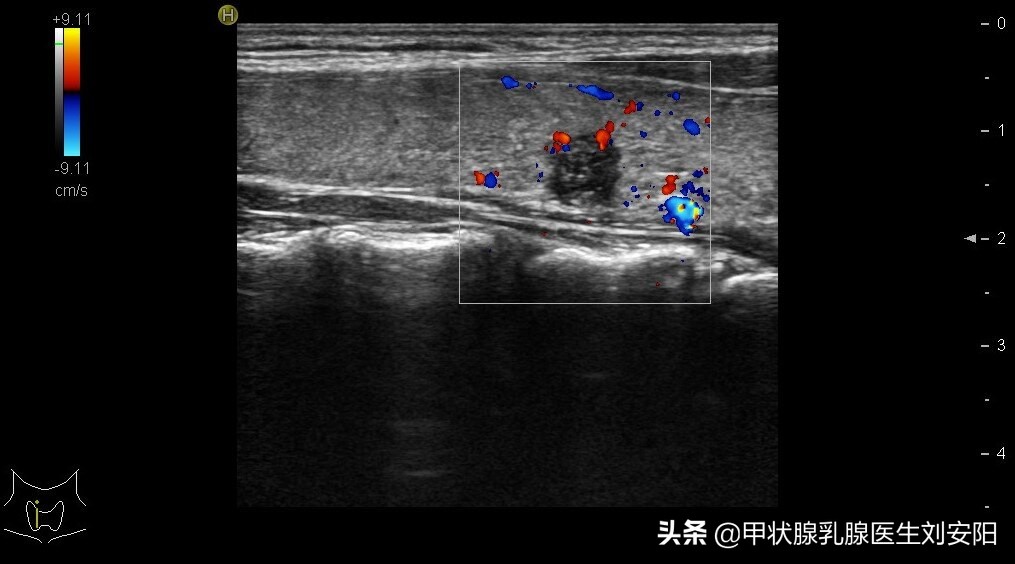 甲状腺癌术后病理发现淋巴转移,甲状腺癌未手术转移病例