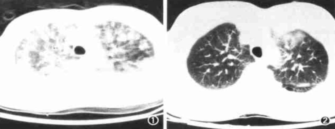 56岁男性发现双肺,56岁男性发现双肺数百个结节