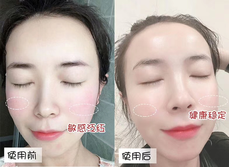 快速缓解痘痘泛红的办法,怎么祛除红血丝敏感痘痘