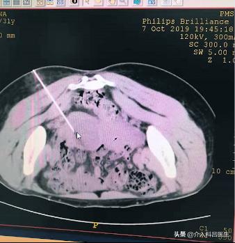 巧克力囊肿保守治疗方法是什么呢,巧克力囊肿如何彻底治愈