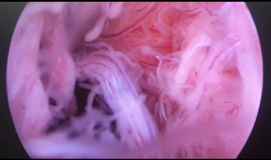 类风湿性关节炎抗风湿药能消肿吗,类风湿关节炎有哪些药是抗风湿的