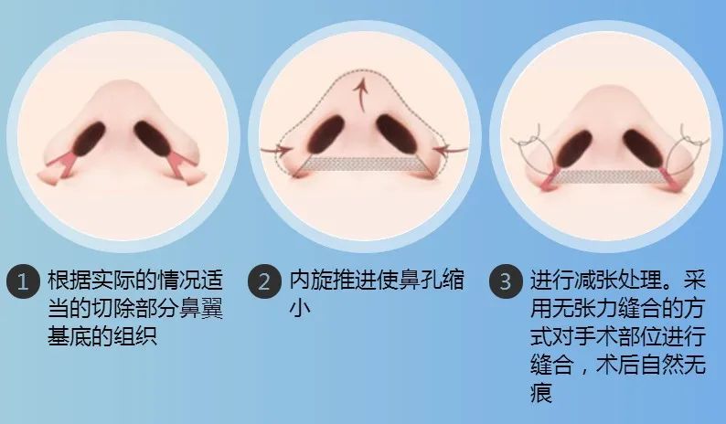 鼻翼缩小和鼻头缩小需要全麻吗,鼻头缩小和鼻翼缩小有什么区别