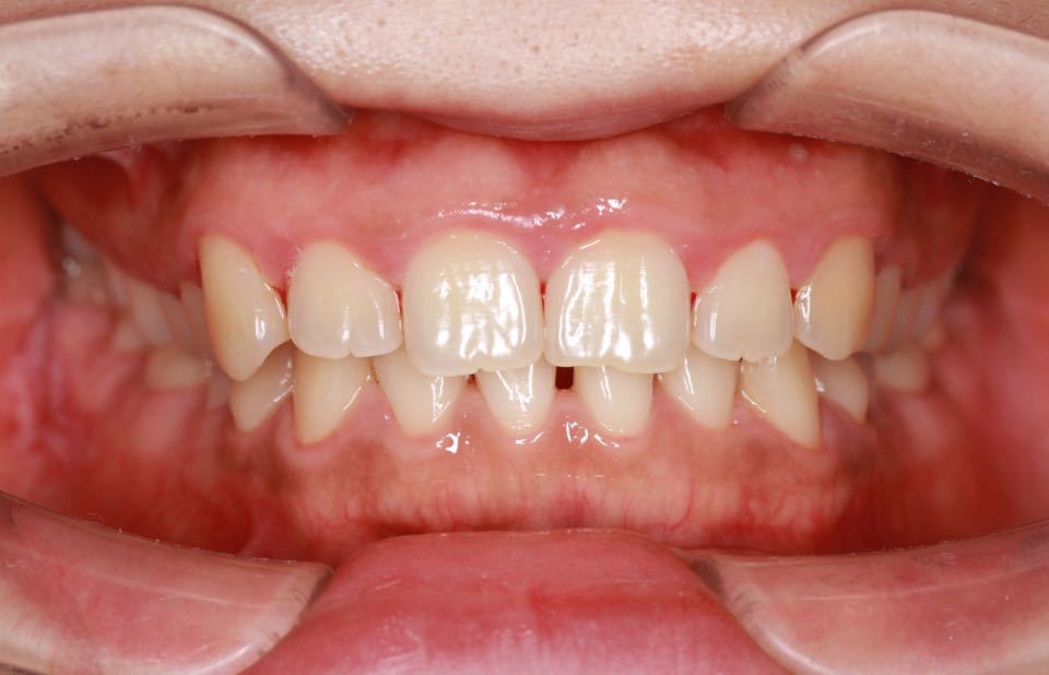 西安张军正畸医生如何,西安牙齿矫正案例