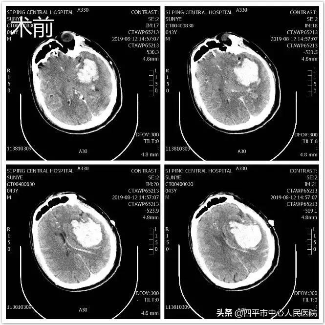 精准排雷再现新高—神经外科在6月份成功救治6例颅内动脉瘤患者