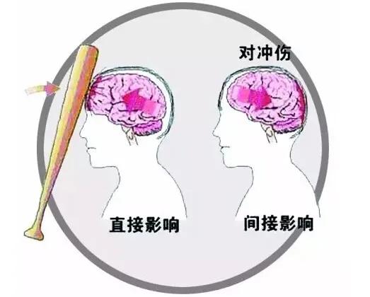头部撞伤后多久出现脑损伤症状,头部受伤一般会有哪些症状