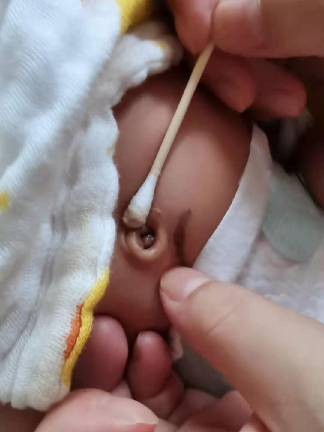 儿童脐茸怎么治,宝宝脐茸怎样处理