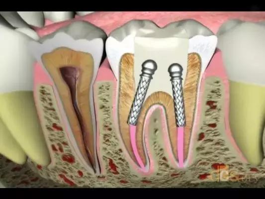 不做根管治疗直接补牙有什么危害,牙疼根管治疗后还疼什么原因