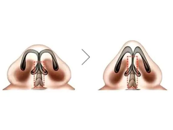 鼻头缩小鼻翼缩小前后对比图,鼻头缩小跟缩小鼻翼有区别吗