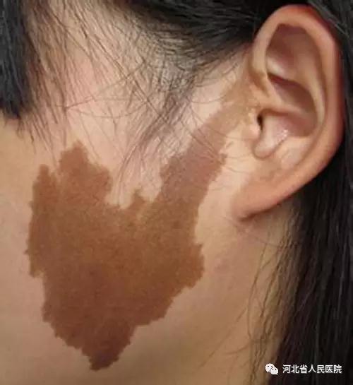 盘点新生儿特有的体征“符号”