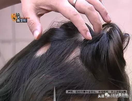 杭州漂亮女孩扎马尾头皮一下秃了四块！她怀疑那次在理发店……
