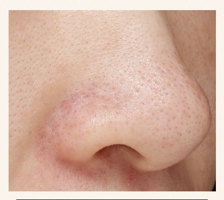 去黑头简单粗暴,去黑头不入坑